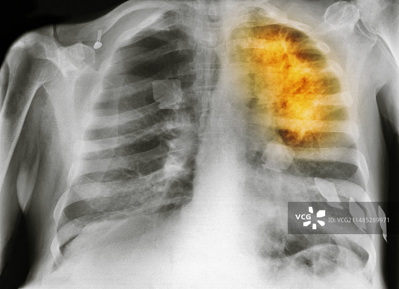 肺癌X光片图片素材