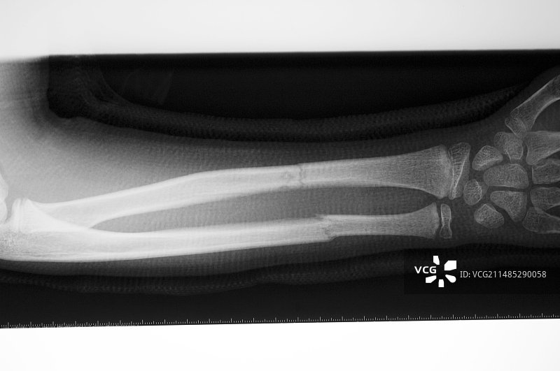 骨折打着石膏的手臂X光片图片素材