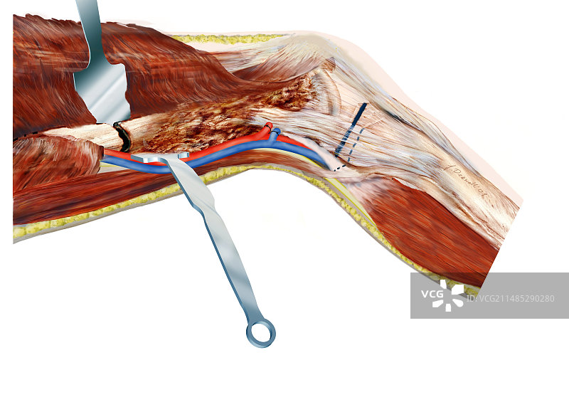 膝关节癌症手术艺术图图片素材