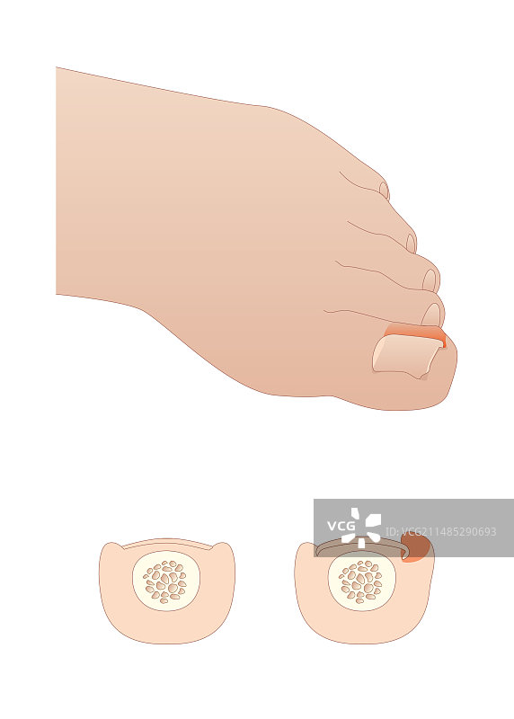 甲沟炎医学插图图片素材