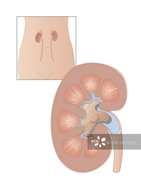 肾结石艺术作品图片素材