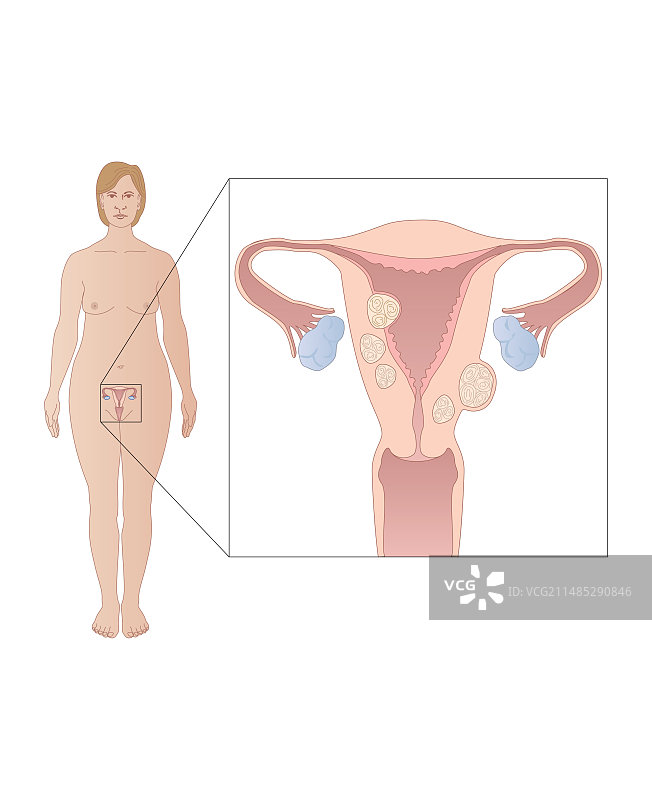 子宫肌瘤医学插图图片素材