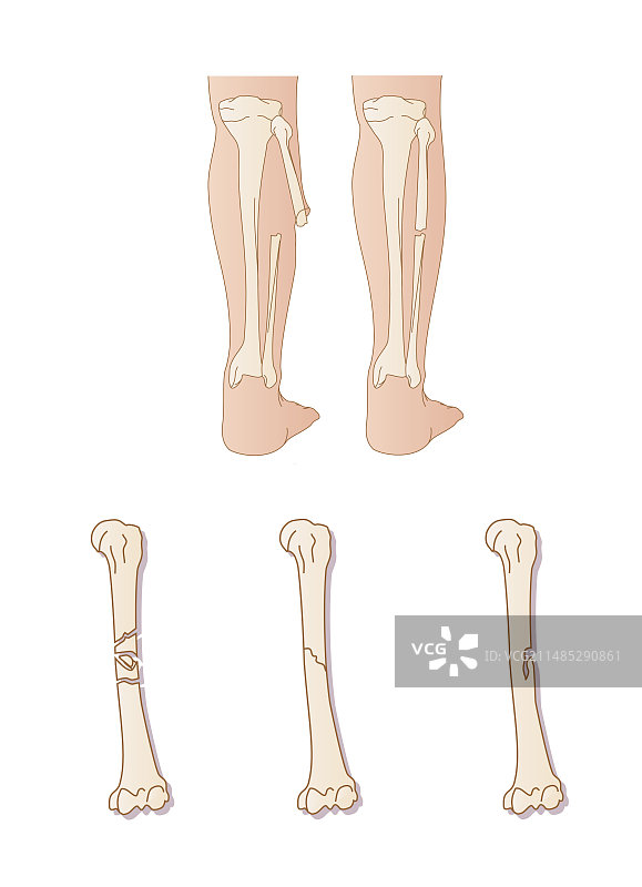 骨折类型图片素材