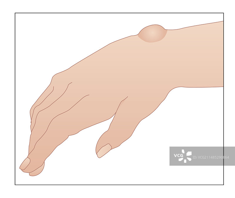 神经节囊肿医学插图图片素材