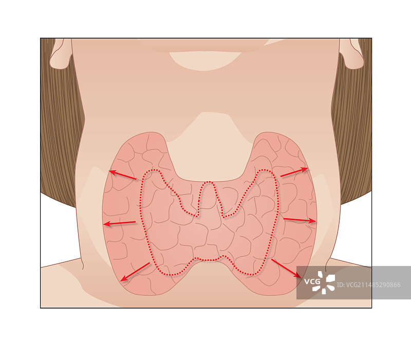 甲状腺肿艺术图图片素材