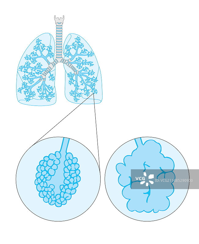 肺气肿艺术图图片素材