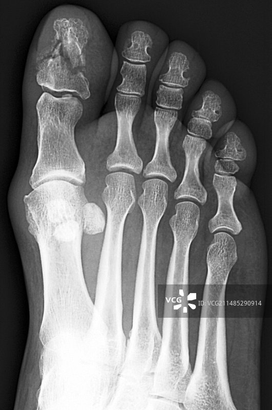 断裂的脚趾骨X光片图片素材