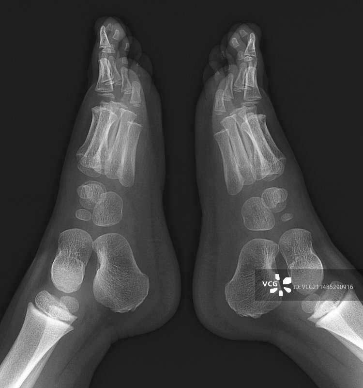 儿童骨骼发育X光片图片素材