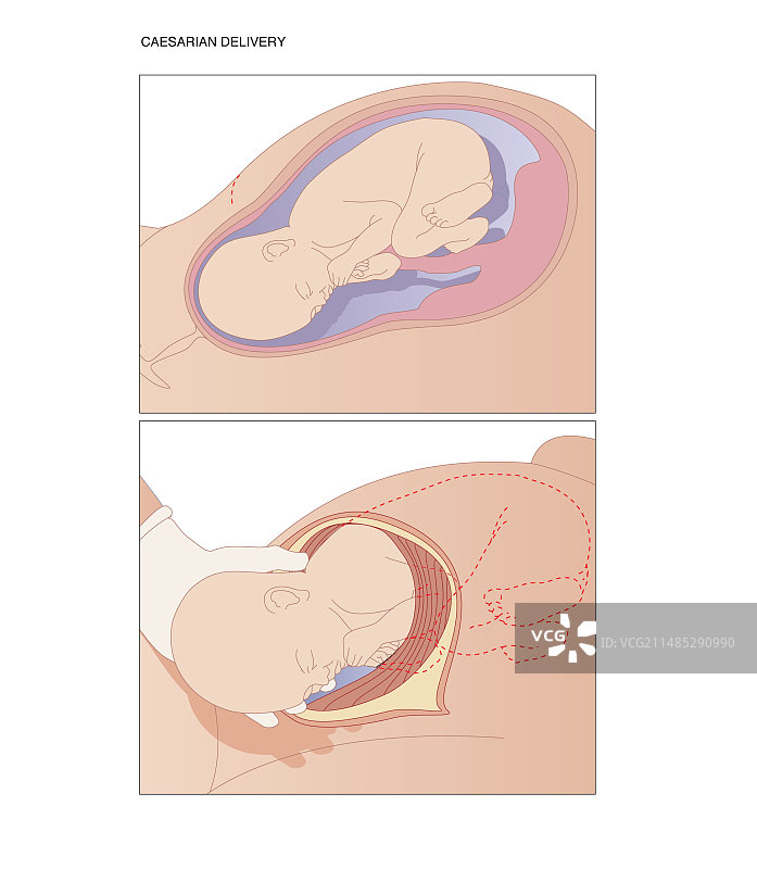 剖腹产，艺术作品图片素材