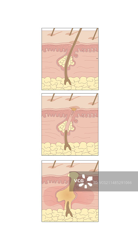 痤疮插画图片素材