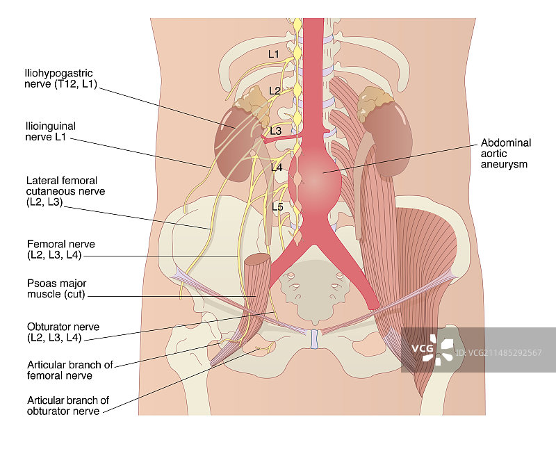 腹主动脉瘤图片素材