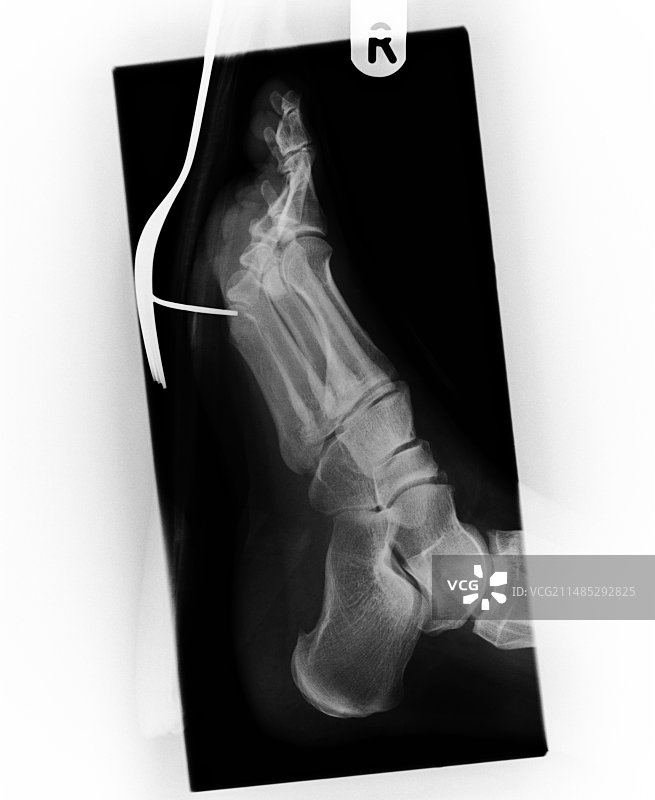 叉子刺穿人脚的X光片图片素材