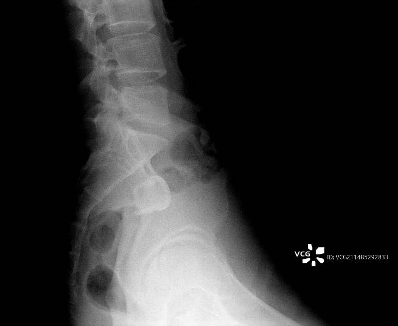 X光片：男人直肠里的饮料瓶图片素材