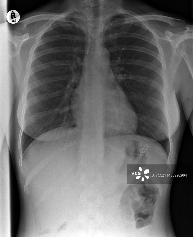 X光片下的吞下的牙刷图片素材