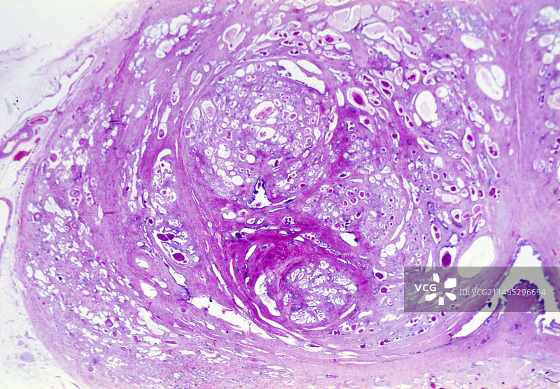 前列腺增生，光学显微照片图片素材