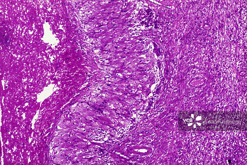 卵巢囊肿光学显微照片图片素材