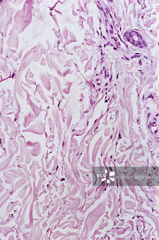 角化棘皮瘤显微照片图片素材