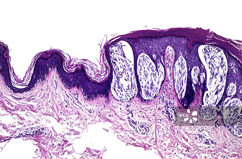 良性痣显微照片图片素材
