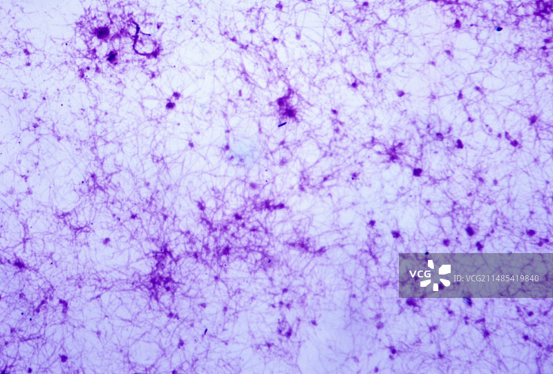 血凝块中分离的纤维蛋白图片素材