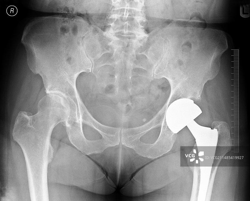 髋关节置换X光片图片素材