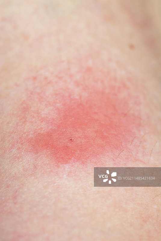 蜜蜂蛰伤图片素材