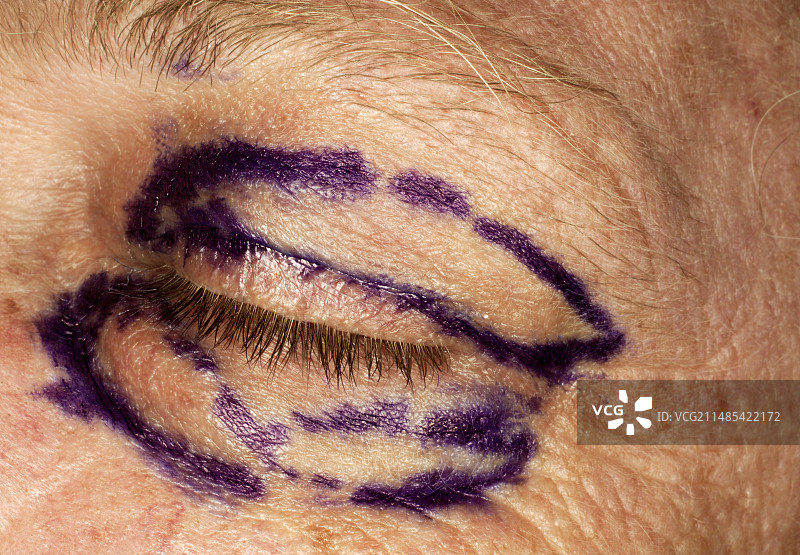 眼睑整形手术图片素材