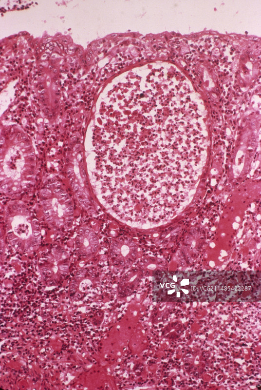 溃疡性直肠结肠炎溃疡（光学显微镜照片）图片素材