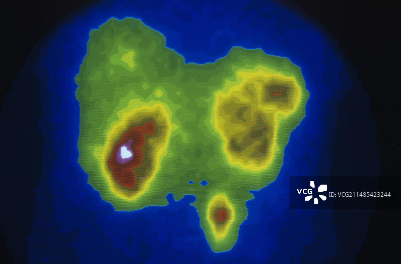 小肠癌闪烁扫描图图片素材