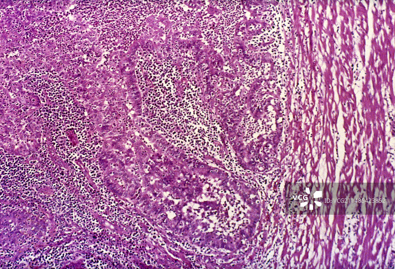 输卵管异位妊娠，光学显微照片图片素材