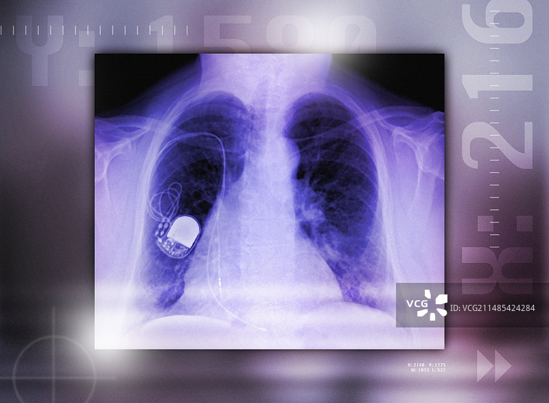 心脏起搏器X光片图片素材