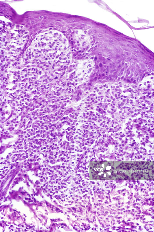 牛皮癣，光学显微照片图片素材