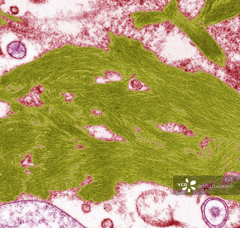 淀粉样变性，TEM图片素材