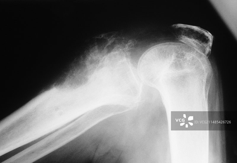 膝关节癌变X光片图片素材