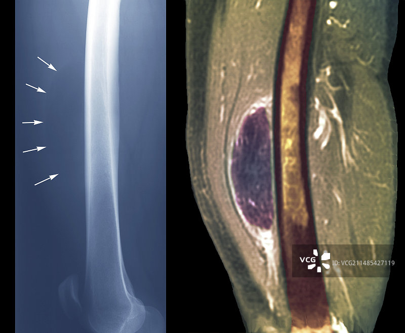 大腿脂肪瘤核磁共振扫描图片素材
