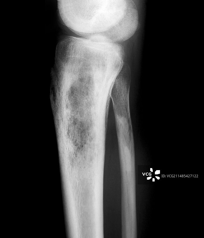 细菌性骨感染X光片图片素材