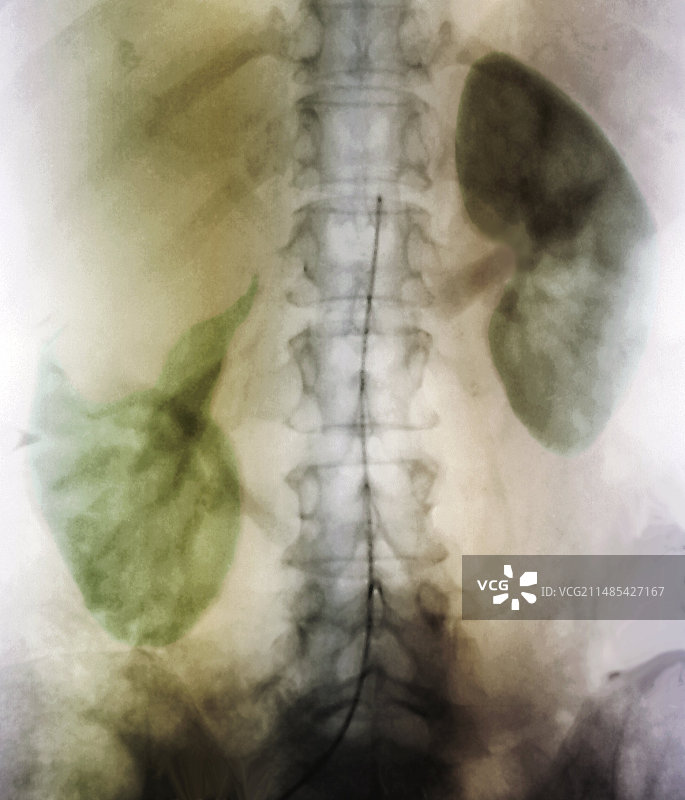肾囊肿血管造影X射线图片素材