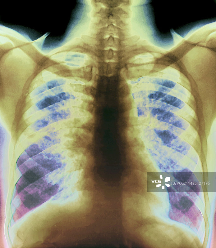 肺部结节病X光片图片素材