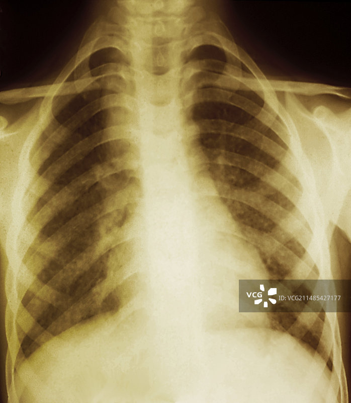 肺结核X光片图片素材