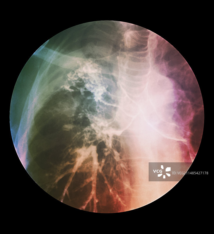 气胸治疗X光片图片素材