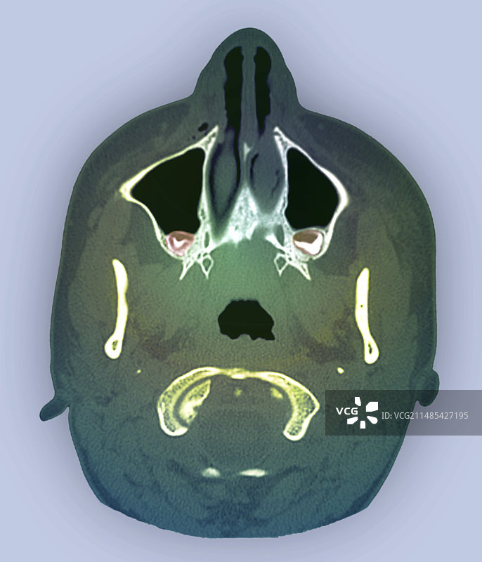 CT扫描中的阻生磨牙图片素材