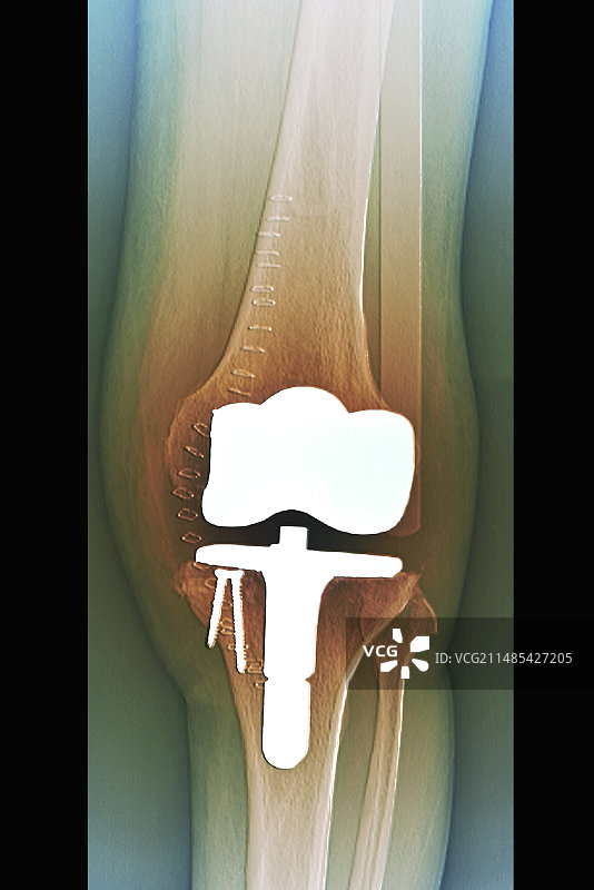 全膝关节置换X光片图片素材