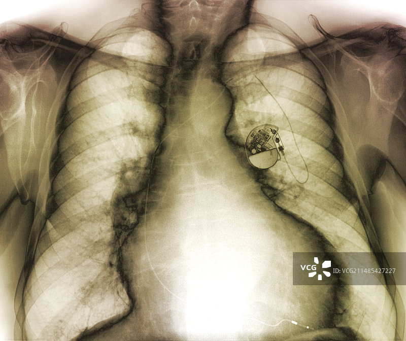 用于心力衰竭的起搏器X光片图片素材