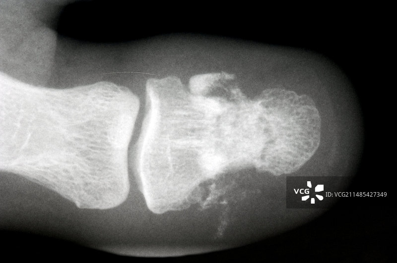 脚趾复杂性骨折图片素材