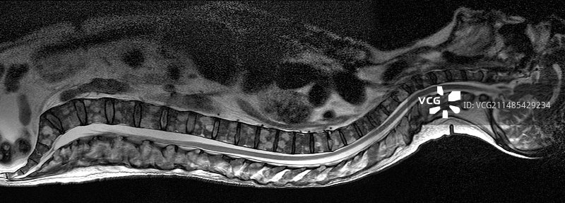 骨髓癌，MRI扫描图片素材