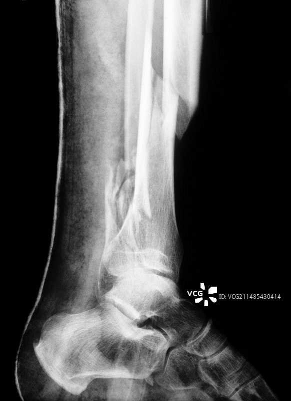 石膏骨折腿部X光片图片素材