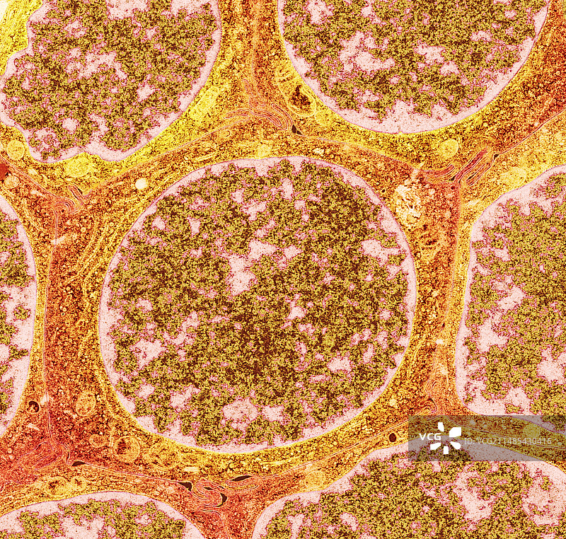 良性乳腺疾病细胞，透射电镜图片素材