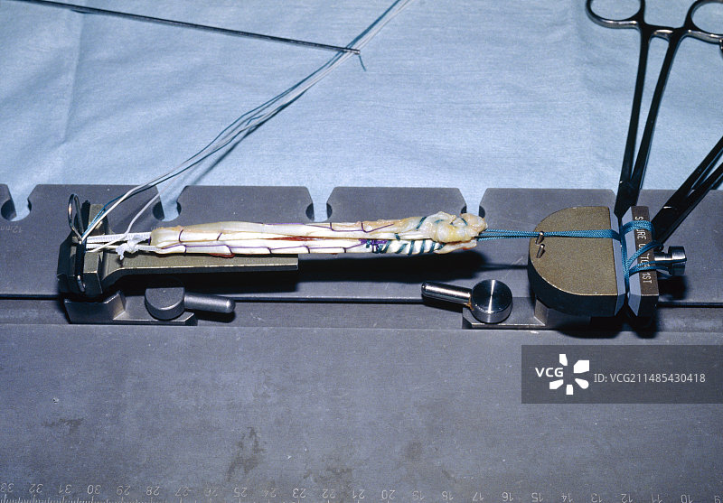 膝关节韧带置换手术图片素材