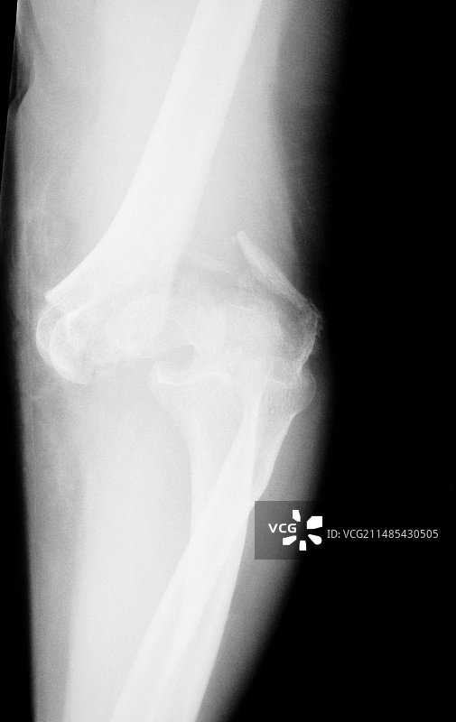 肘部骨折X光片图片素材