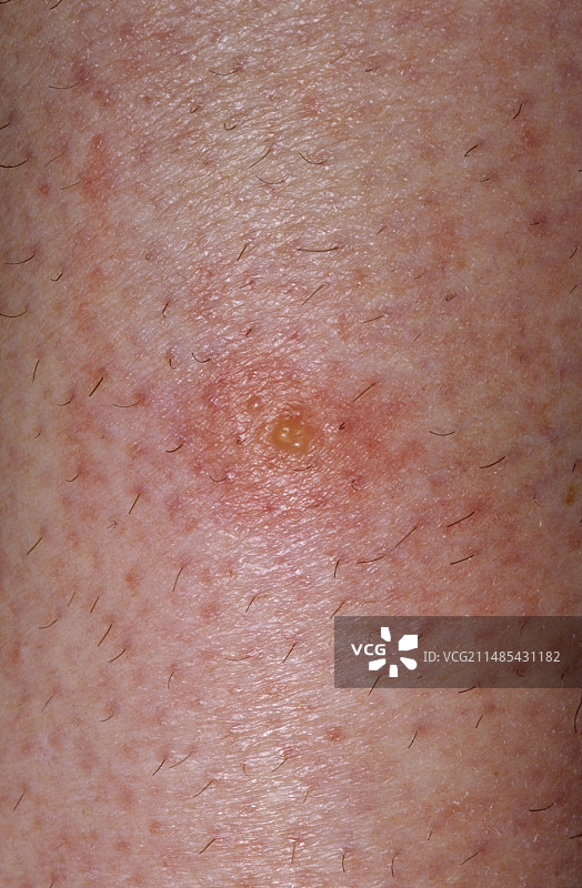 昆虫叮咬图片素材