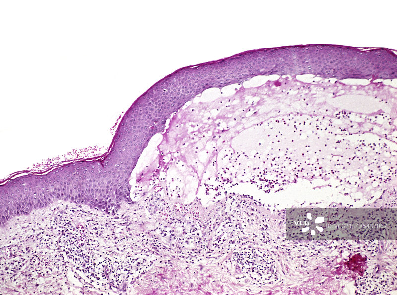 水泡，光学显微照片图片素材